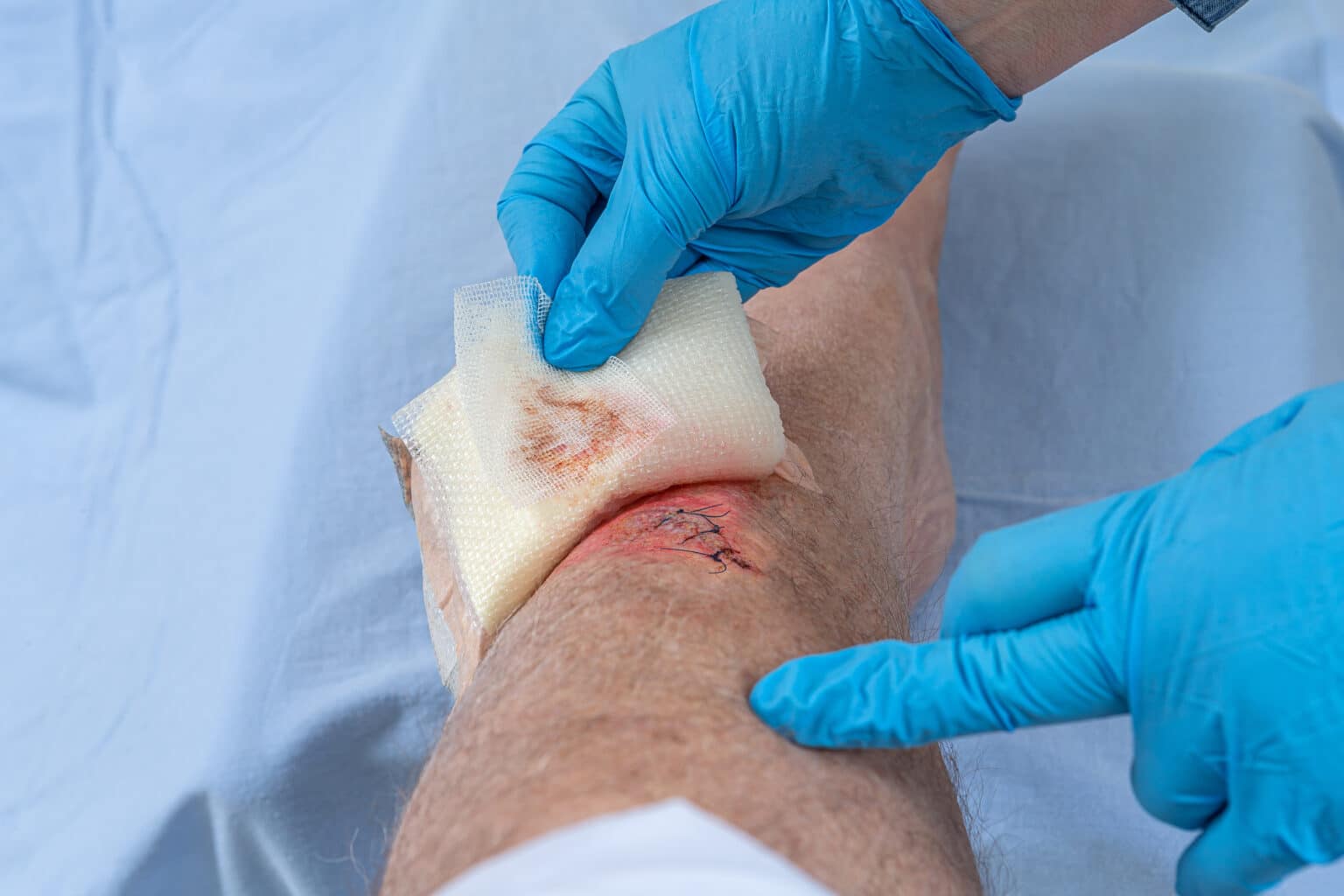 Suture Removal CPT Codes and How to Use Them - Net Health