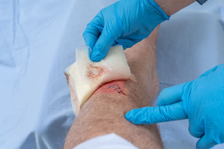 surgical wound is treated by nurse