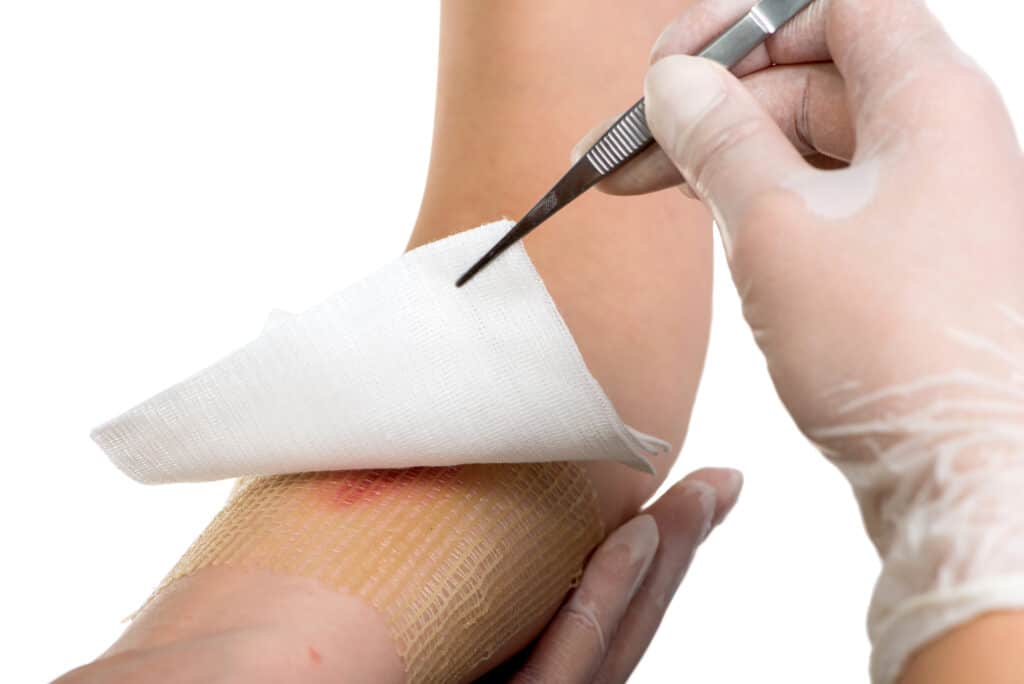 nurse treats a type of diabetic wound