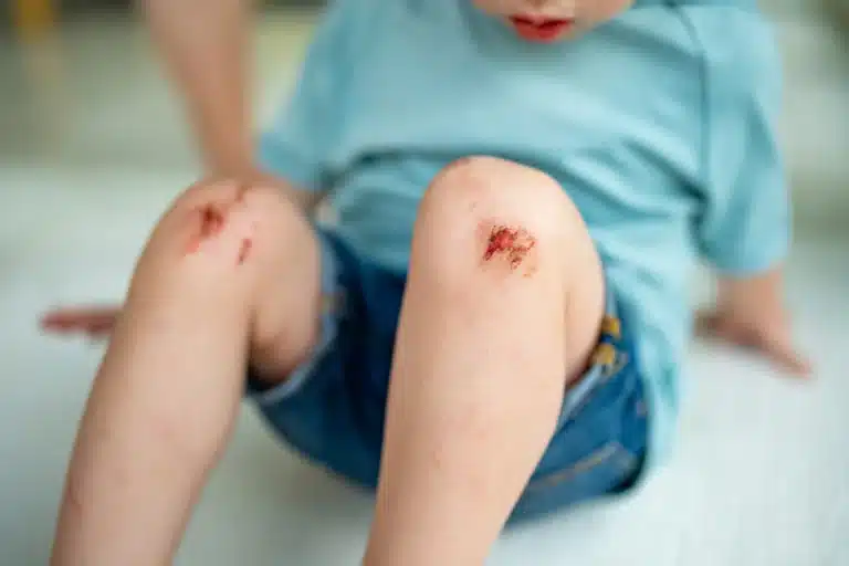 A little boy has superficial wounds on his knees